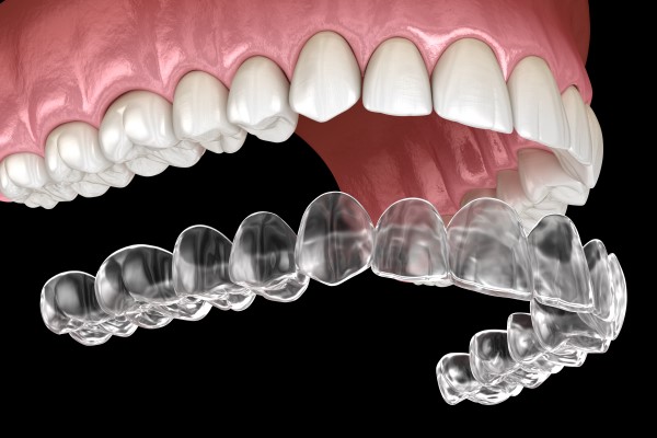 The Art of Precision: How Invisalign Aligners Ensure Optimal Dental Alignment